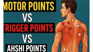 Motor points 🆚 Trigger points 🆚 Ahshi points