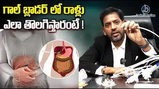 గాల్ బ్లాడర్ లో రాళ్లు ఎలా తొలగిస్తారంటే !| Dr. Chandra Shekhar Puli | London Gastro Care