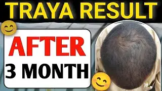 Traya Result After 3 Month | Hair Regrowth Journey 