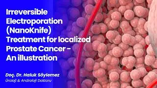 Irreversible Electroporation (NanoKnife) Treatment for localized Prostate Cancer - An illustration