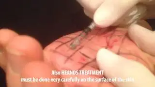 Hyperhidrosis treatment with botulinum toxin