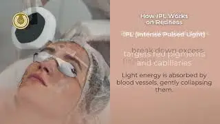 Can Laser Fix Redness or Rosacea? | IPL & PICO Laser Explained
