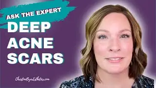 Your questions:  Deep Acne Scars