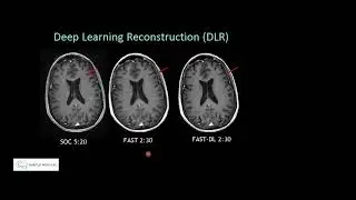 SubtleMR: Deep Learning Reconstruction, Compared to SOC - Suzie Bash, MD