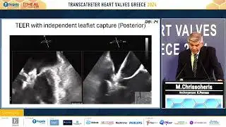 M. Chrissoheris | 2. Imaging in pre and post M-TEER