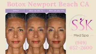 Botox Forehead Newport Beach CA (949) 652-2600