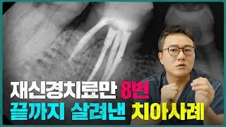 재신경치료 포기해야할지 판단하는 방법은 이것만 알면 됩니다!