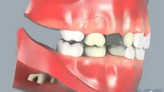 Shawnee Dental Shares Crown Placement in Shawnee, OK