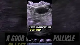 Dominant Ovarian Follicle   #Ultrasound #pregnancy #infertility #ovulation