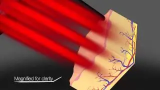 PicoSure Focus
