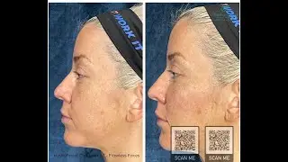 Hydrafacial Chandler AZ - Flawless Faces