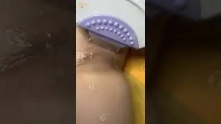 Quy tr&igrave;nh triệt l&ocirc;ng n&aacute;ch v&agrave; trị th&acirc;m n&aacute;ch c&ugrave;ng nhau tại Midu Spa