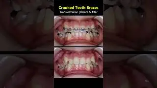Braces Journey: Straightening Crooked Teeth #braces #dentist #orthodontist #teeth #tooth