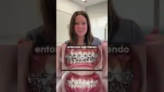 Proceso brackets o ortodoncia