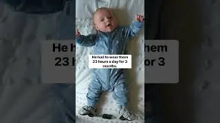 Club Foot Journey | Abram is walking! #momlife #baby #clubfoot #shorts