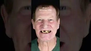 All on 4 Dental Implants in Cancun, Mexico: Before & After Transformation! #dentalimplantsmexico