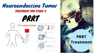 PRRT Treatment Neuroendocrine Tumors