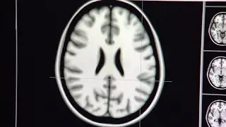 Heavy teen marijuana use may cause memory problems