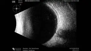 20 MHz Annular Ophthalmic Ultrasound ABSolu, Prominent cup , 36914