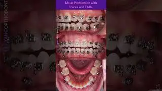 Closing missing tooth space by protracting molars forward with braces and TADs. #orthodontics