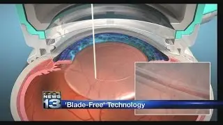 'Blade-Free' Technology Now Available for Cataract Surgeries
