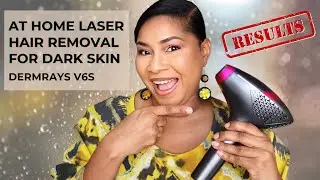 Say GOODBYE to Unwanted Hair with Dermrays V6S Laser Hair Removal!