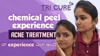 Chemical peel treatment experience part 1