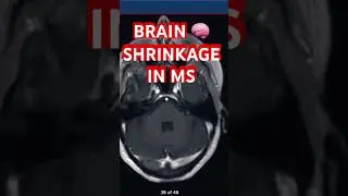 Brain 🧠 Shrinkage & Black Holes in Multiple Sclerosis
