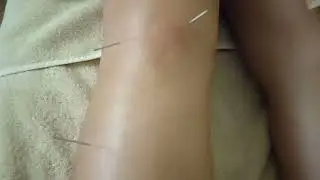 House Call Sport Acupuncture 001