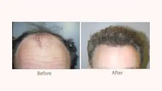 Ferguson Clinic NeoGraft HD