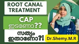 ROOT CANAL Treatmentന് ശേഷം CAP നിര്‍ബന്ധമാണോ? CAP ഇട്ടില്ലെങ്കില്‍ കുഴപ്പമുണ്ടോ?|| Dr Shemy M R