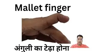 Mallet finger: अंगुली का टेढ़ा होना