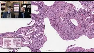 Pattern 2 - Rheumatoid arthritis associated interstitial fibrosis