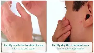 NewGel+ Silicone Gel Application Tutorial | Scar Care Made Easy