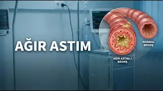 Ağır Astım