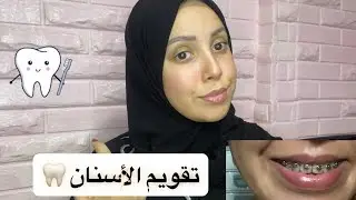 درت les bagues 😬 ركبت تقويم أسنان: الثمن ، الألم و المدة اللازمة / مشكلة الفك السفلي 