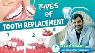 Types Of Tooth Replacement Available | Teeth Replacement || Dr. Anoop Chowdary || Expert Dental Care
