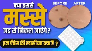 Are Skin Tag Patches SAFE The Hidden Dangers You Need to Know