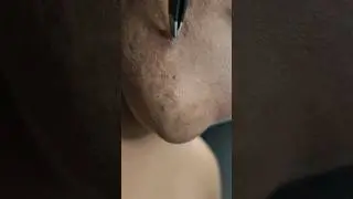 Tweezing Stubborn Facial Hairs#waxing #tweezers #ingrownhair #acnescars #relaxing #ingrownhair #hair