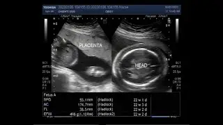 Hydrops fetalis, with Fetal Soft tissue edema,  Ascites, and Pleural effusion.