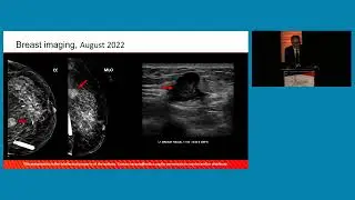 SABCS 2023: Molecular Tumor Board