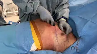 GYNECOMASTIA TREATMENT - Procedure overview and video