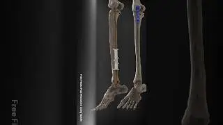 Jaw Reconstruction using Fibula Free Flap | Cutting Guides | Patient-Specific Fixation plates