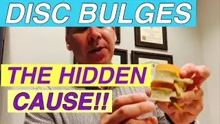 DISC BULGES | THE HIDDEN CAUSE!!  Dr Frank Altenrath Chiropractor in Cresskill NJ
