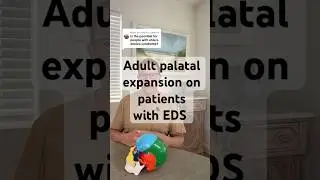 Is it possible to do adult palatal expansion on patients with Ehlers Danlos syndrome? ￼#maspe