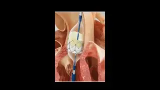 Transcatheter aortic valve implantation (TAVI) #science #shorts #anatomy