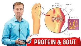 Why Does Dietary Protein NOT Cause Gout? &ndash; Dr.Berg