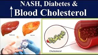 One year after MGB|Weight loss surgery|Best Bariatric surgeon|Dr.Kular|India|Punjab|