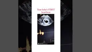 Your Baby&rsquo;s FIRST Heartbeat on Ultrasound!💓 #drbhumikabansal #heartbeat #pregnancy #trending #short