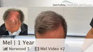 Norwood 5 Hair Transplantation Surgery Results 1 Year Later | Dr. Kevin Blumenthal (Mel)